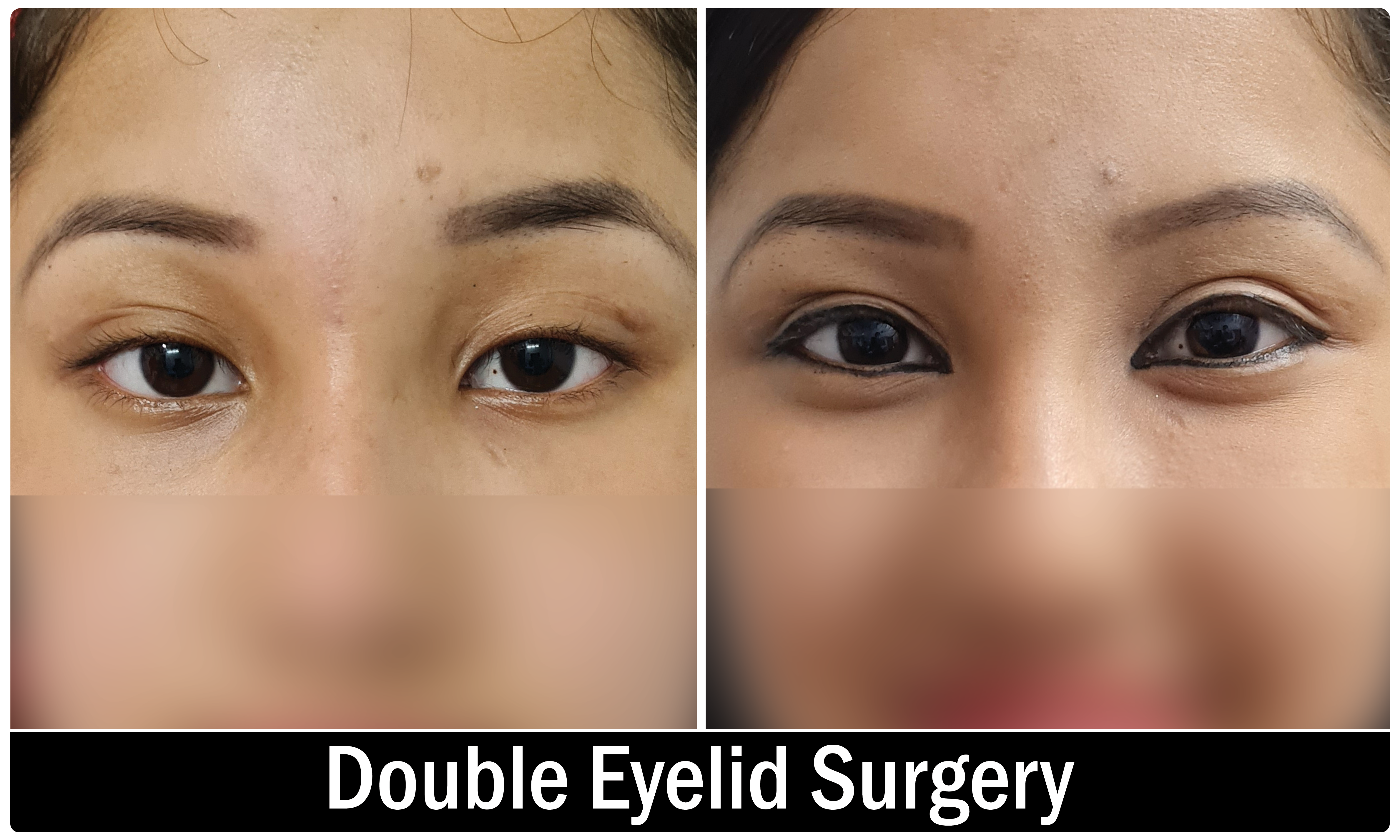 Eyelid Surgery KOQ10